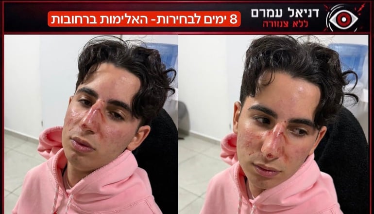 נער בן 15 מפתח תקווה הותקף בתחנת אוטובוס על ידי חבורת נערים, לדברי אמו